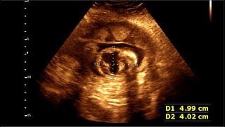 Cystic Hygromas  Cervical teratoma  Sonographic prediction of cystic hygroma [upl. by Maida125]