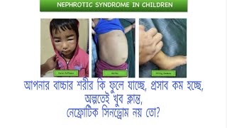 Nephrotic Syndrome patient is better After Application of Homeopathic Medicine [upl. by Haran945]