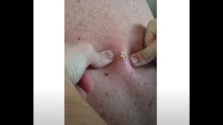 Popping Dad’s Cyst at Home By DR Blackhead [upl. by Blythe634]