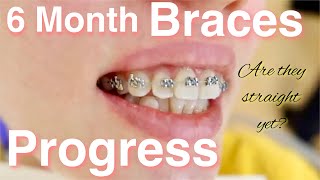 6 months braces progress in less than 2 minutes Video and phone time lapse [upl. by Faydra]