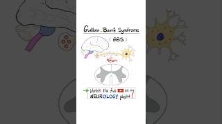 GuillainBarré Syndrome GBS Acute Inflammatory Demyelinating Polyradiculoneuropathy AIDP [upl. by Ojibbob]