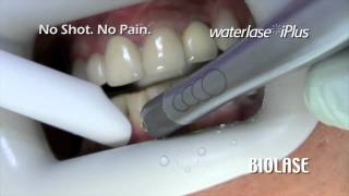 BIOLASE No Anesthetic Painfree Class V WaterLase iPlus Cavity Preparation [upl. by Nybor]