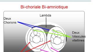 GYNECOLOGIE Grossesses multiples TDD Grossesse Gemellaire [upl. by Nove772]