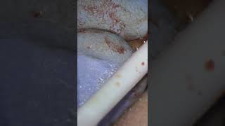 Cyst on the tooth  dental cyst  tooth extraction and cysts dentistry toothdental dentist [upl. by Ecirtahs]