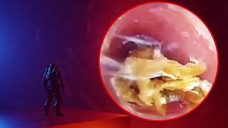 The Truth About earwax Will Shock You How to remove earwax from ear earwax extractions [upl. by Pergrim762]