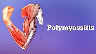 Polymyositis amp Dermatomyositis [upl. by Valdis]