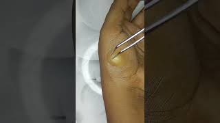 blackheads spa doctor satisfying pimple removal blackheads [upl. by Nugesulo]