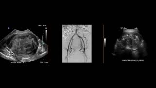 Fibroid on ultrasound post uterine artery embolization [upl. by Hartzell]