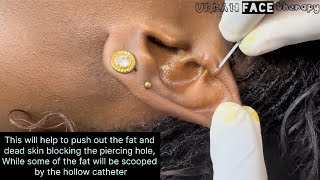 Reopening a blocked piercing No needle used earpiercing [upl. by Kato471]