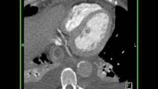 Cardiac Aortic dissection with compression of the true lumen by false lumen 1 of 4 [upl. by Stahl735]