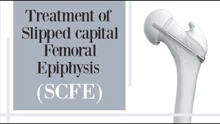 treatment of slipped capital femoral epiphysis SCFE  hip pain in children [upl. by Lupita]