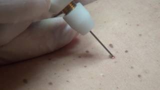 Hyperkeratosis removal with Plexr [upl. by Manvell490]