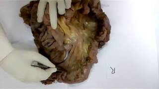 Evidence of Continuity of Mesentery from Duodenum to Rectum from Human Cadaveric Dissection [upl. by Tenn964]