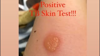 POSITIVE TB SKIN TEST [upl. by Spiro]