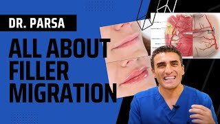 All About Filler Migration with Dr Parsa [upl. by Bevash]