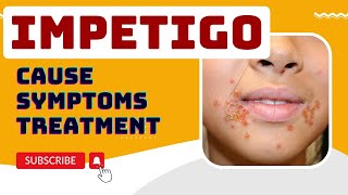 Impetigo  impetigo skin infection  cause Symptoms  treatment  bullous Impetigo  school sore [upl. by Ynatsed]