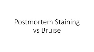 Postmortem Hypostasis vs Bruise  Forensic Medicine FMT [upl. by Oirad]