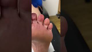 Experience relief Watch an Aussie podiatrist tackle a pinch callus [upl. by Eitac538]