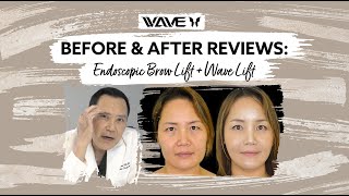 Before and After Endoscopic Brow lift with a Mini Facelift Wavelift  Wave Plastic Surgery [upl. by Ahseat]