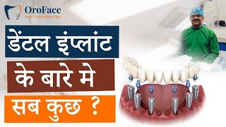 Dental Implant के बारे मे सबकुछdentalcaredentalimplantsdental [upl. by Odell897]