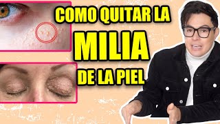 Como Quitar La Milia De La Piel ¿Porque Sale [upl. by Ellasal]