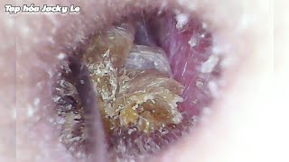 Ear Wax Removal 117 Please My Earwax Is So Itchy That I Cant Sleep  Ear Cleaning ASMR [upl. by Ulah]