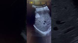 Hemangioma Ultrasound  Liver Mass sonography  ARDMS  Radiology Sonographer [upl. by Acnaiv]