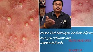 SKINDISEASES FOLLICULITIS amp FURUNCULOSIS TREATMENT IN TELUGU HOMEOPATHY WAKEUP [upl. by Curhan784]