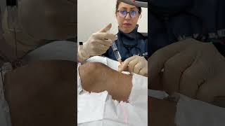 🏋️‍♀️ How is genicular nerve block done [upl. by Assiron126]