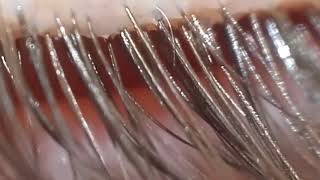 Removing Demodex on my eyelashes 4 [upl. by Silma]