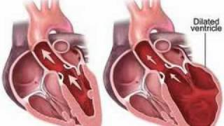 Cardiomyopathy Symptoms │ Symptoms of Cardiomyopathy [upl. by Britte]