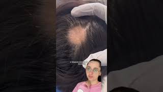 Cómo hacer crecer el cabello rápido l La verdad del MINOXIDIL [upl. by Keemahs742]