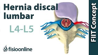 Hernia discal lumbar entre la L4 y L5 o cuarta y quinta vértebras lumbares [upl. by Griffith]