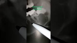 23 Odontogenic keratocyst radiograph [upl. by Ereveneug]