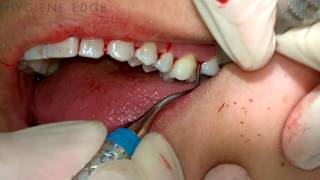 Gracey Instrumentation During Periodontal Therapy [upl. by Avah]