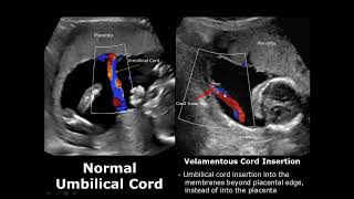 Umbilical Cord Ultrasound Normal Vs Abnormal Image Appearances Comparison  Fetal USG  Obstetric [upl. by Enicar]