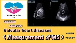 Measurement of MS 승모판 승모판 협착증 승모판협착 평가 승모판협착 측정 MS echocardiography 심장초음파 판막질환 [upl. by Marilyn588]