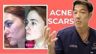 The Best Acne Scar Treatments Explained  Dr Davin Lim [upl. by Ydualc]