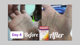 HOW TO GET RID OF WARTS AT HOME  Paano Tanggalin ang warts sa bahay [upl. by Tare]