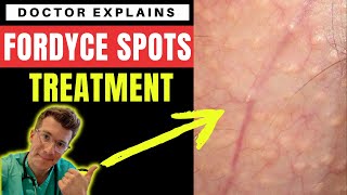 How to treat FORDYCE SPOTS  Doctor ODonovan explains [upl. by Ntsud402]