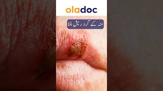 Facial Herpes How To Treat  Oral Herpes Prevention  Mouth Sores Ka Ilaj shorts youtubeshorts [upl. by Capriola]