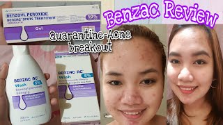 How to Use Benzoyl Peroxide Gel 25 for THE BEST RESULTS 2021 [upl. by Verger]