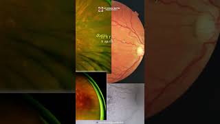 White Dot Syndromes ophthalmology optometry uveitis eyedisease choroidopathy [upl. by Chip]