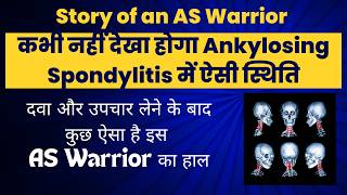 Ankylosing Spondylitis Patient Stories  Ankylosing Spondylitis Patient With Rare Symptoms  HLA B27 [upl. by Llerref742]