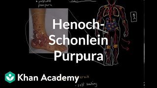 HenochSchonlein purpura  Circulatory System and Disease  NCLEXRN  Khan Academy [upl. by Edison]