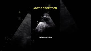 Aortic Dissection with freeflow between True and False Lumen echocardiography [upl. by Doxia]