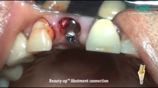 BGBRBMP Guided Bone Regeneration with Beautyup Abutment amp Natural Tooth [upl. by Rosenberg]