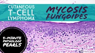 Mycosis Fungoides Cutaneous TCell Lymphoma 5Minute Pathology Pearls [upl. by Adlanor]