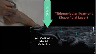 Deltoid Ligament Ultrasound 2023 [upl. by Algie]