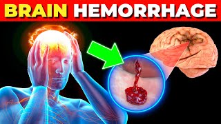 What Happens in Brain Hemorrhage  Symptoms Causes and Treatment [upl. by Neelyk]